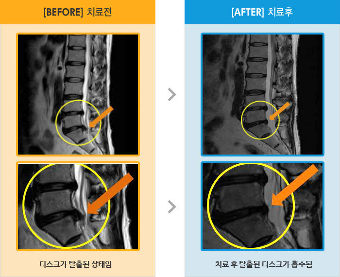 자생한방병원 치료사례 MRI로 보는 치료결과-엉치 부터 다리 뒤쪽으로 통증과 저림