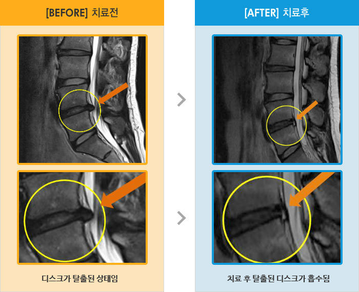 자생한방병원 치료사례 MRI로 보는 치료결과-오후가 되면 허리 통증, 양측 둔부 및 허벅지 후면 저림 
