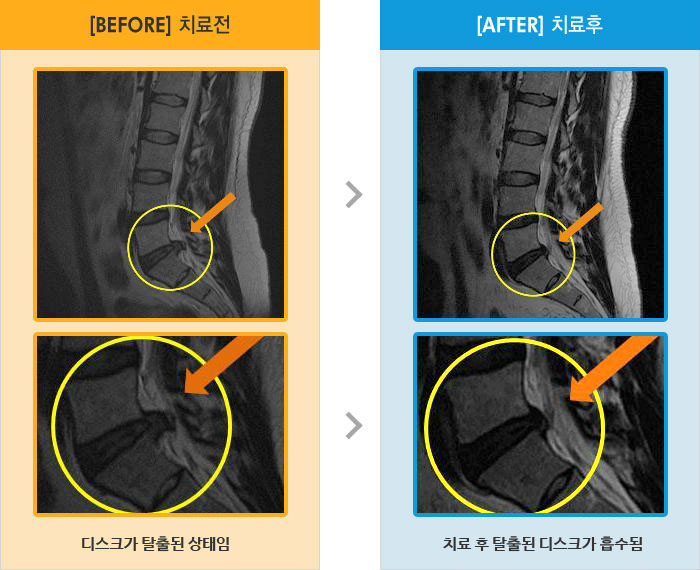 자생한방병원 치료사례 MRI로 보는 치료결과-우측허리와 골반쪽의 통증으로 허리를 거의 90도 정도 구부려서 보행