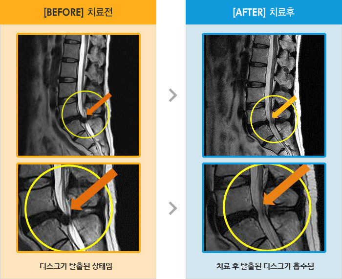 자생한방병원 치료사례 MRI로 보는 치료결과-허리 통증과 우측 다리 통증으로 걷거나 앉아있을 때, 운전할 때, 누웠을 때 통증