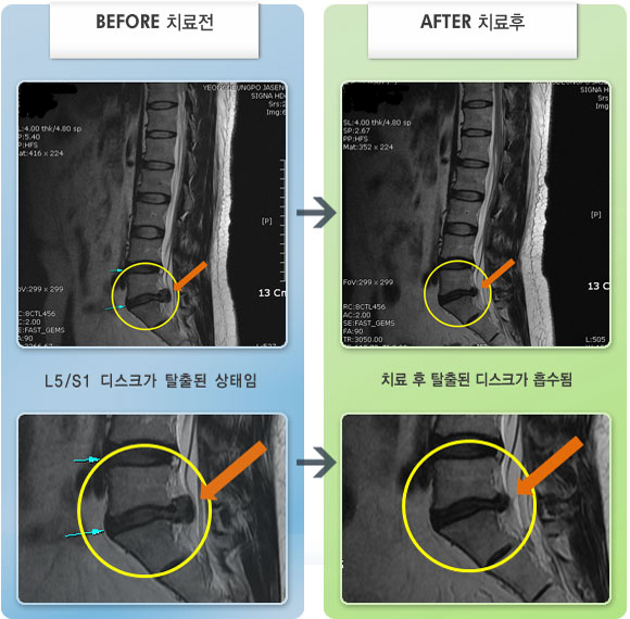 자생한방병원 치료사례 MRI로 보는 치료결과-요통과 우측 둔부, 하지 통증으로 보행시 쉬었다 걸어야 하는 상태