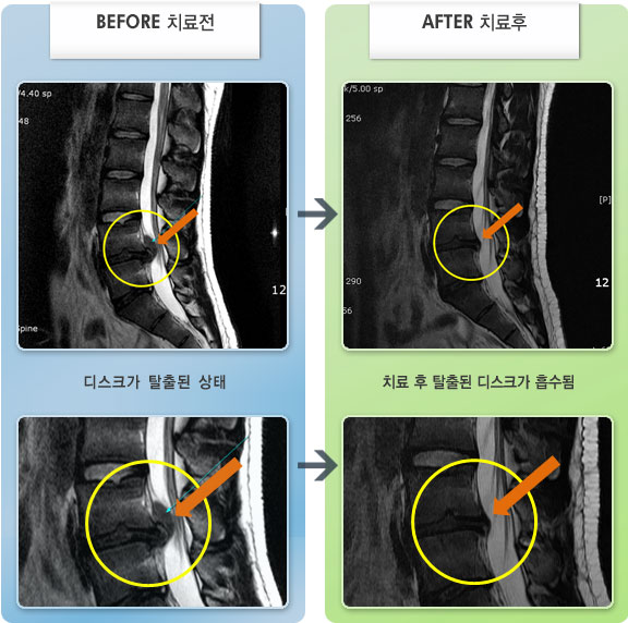 자생한방병원 치료사례 MRI로 보는 치료결과-허리 엉치가 결리는 통증