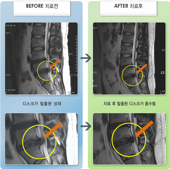 자생한방병원 치료사례 MRI로 보는 치료결과-좌측 허리 통증과 좌측 하지 감각장애