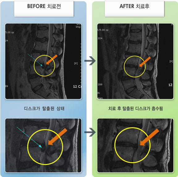 자생한방병원 치료사례 MRI로 보는 치료결과-허리 통증과 오른쪽 허벅지에서 발목까지 당기고 저리고 찌릿한 증상