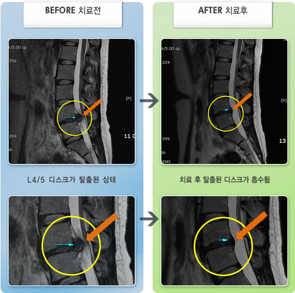 자생한방병원 치료사례 MRI로 보는 치료결과-L4/5 디스크 수술을 받았으나 재발