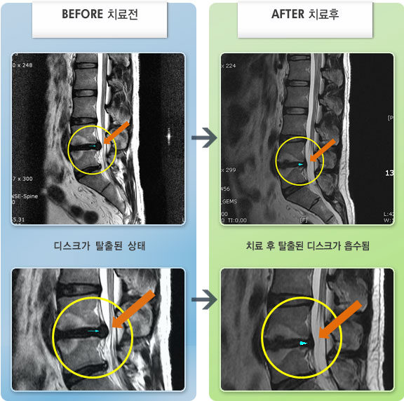 자생한방병원 치료사례 MRI로 보는 치료결과-허리 통증이 심하여 바로 펴기 어렵고, 앉다가 서는게 힘든 상태