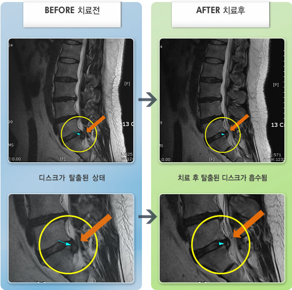 자생한방병원 치료사례 MRI로 보는 치료결과-좌측 엉치와 다리가 저림, 당김이 마치 찢어질듯한 통증