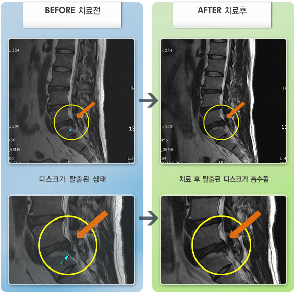 자생한방병원 치료사례 MRI로 보는 치료결과-왼쪽 종아리 당김 증상 및 골반의 심한 통증