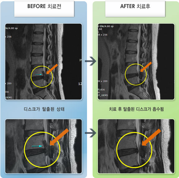 자생한방병원 치료사례 MRI로 보는 치료결과-허리 전체적인 통증으로 움직임이 제한된 상태이며 좌하지 발가락이 시림
