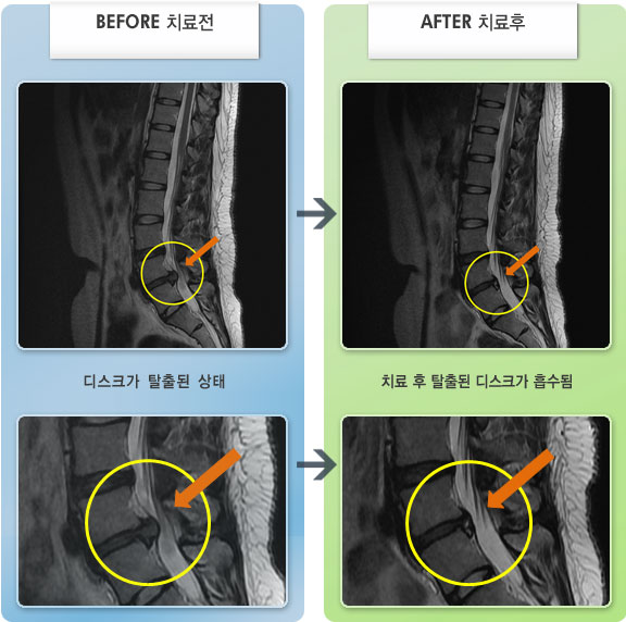 자생한방병원 치료사례 MRI로 보는 치료결과-허리를 움직이기 힘들고 우측 하지 저림이 있는 상태였다.