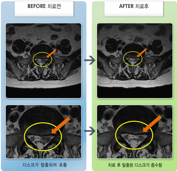 자생한방병원 치료사례 MRI로 보는 치료결과-엉치, 다리 통증 및 보행이 힘든 상태였다.