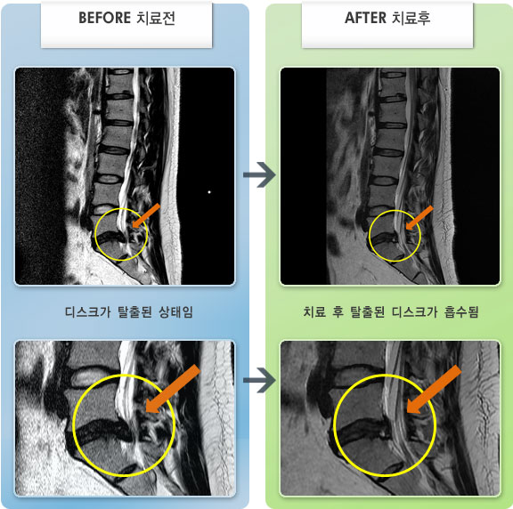 자생한방병원 치료사례 MRI로 보는 치료결과-허리디스크로 인한 하지 방산통