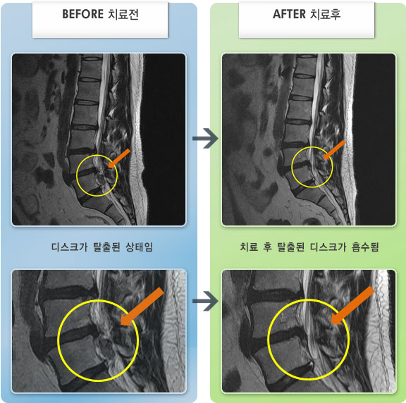 자생한방병원 치료사례 MRI로 보는 치료결과-허리디스크로 인한 허리 통증 및 하지 방산통