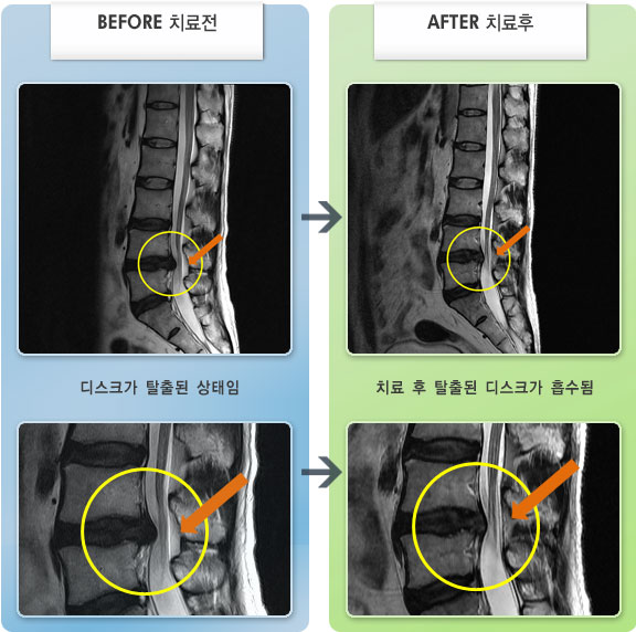 자생한방병원 치료사례 MRI로 보는 치료결과-허리디스크로 인한 우측 요추부 통증