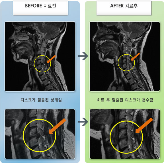 자생한방병원 치료사례 MRI로 보는 치료결과-목디스크로 인한 오른쪽 어깨 및 상박 통증