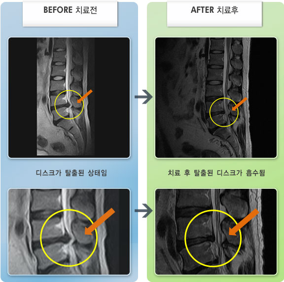 자생한방병원 치료사례 MRI로 보는 치료결과-허리디스크로 인한 요통 및 방사통
