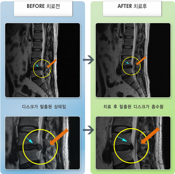 자생한방병원 치료사례 MRI로 보는 치료결과-허리디스크로 인한 허리 통증 및 우측 엉치, 다리 저림 증상