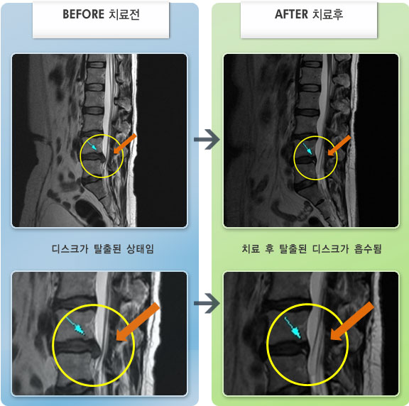 자생한방병원 치료사례 MRI로 보는 치료결과-허리디스크로 인한 허리 통증 및 우측 엉치, 꼬리뼈 통증