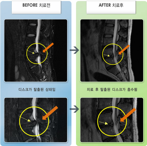 자생한방병원 치료사례 MRI로 보는 치료결과-요추부 통증과 양측 하지 통증