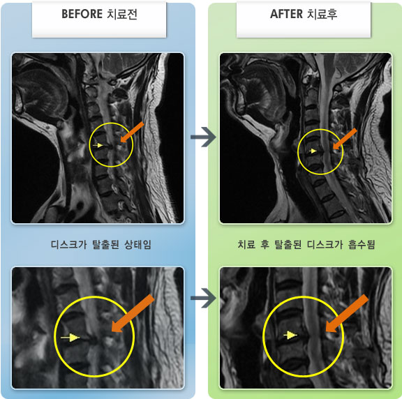 자생한방병원 치료사례 MRI로 보는 치료결과-목과 왼쪽 팔에서 1,2번째 손가락까지 저리고 당기는 통증