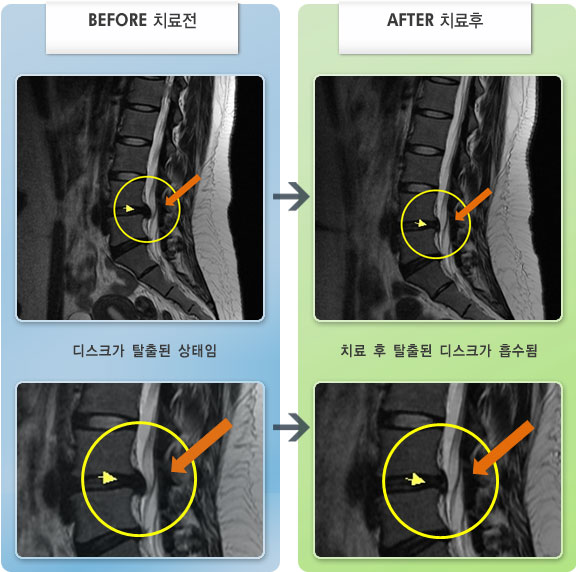 자생한방병원 치료사례 MRI로 보는 치료결과-허리 통증과 우측 엉치에서 발끝 저림 증상