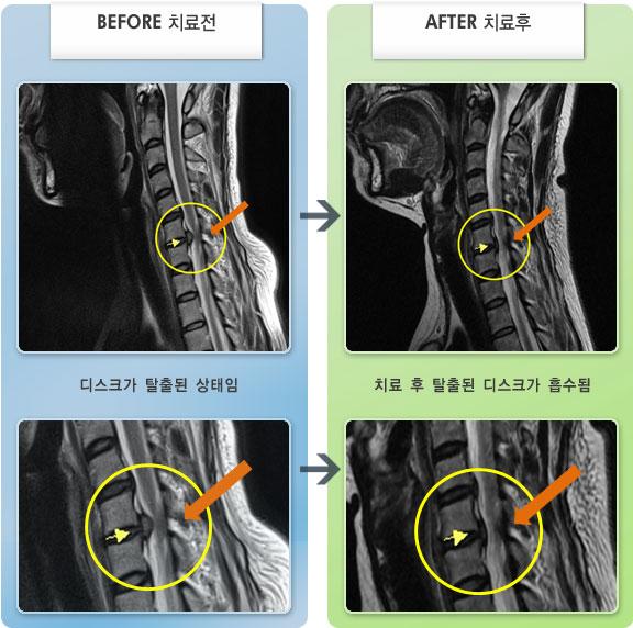 자생한방병원 치료사례 MRI로 보는 치료결과-목 디스크가 터져서 목,등 통증이 있고 팔 저림도 심하였다.