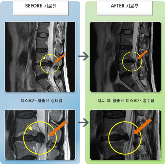자생한방병원 치료사례 MRI로 보는 치료결과-허리와 양쪽 다리 통증