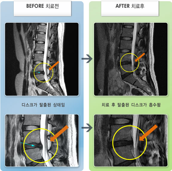 자생한방병원 치료사례 MRI로 보는 치료결과-허리 왼쪽과 꼬리뼈 통증