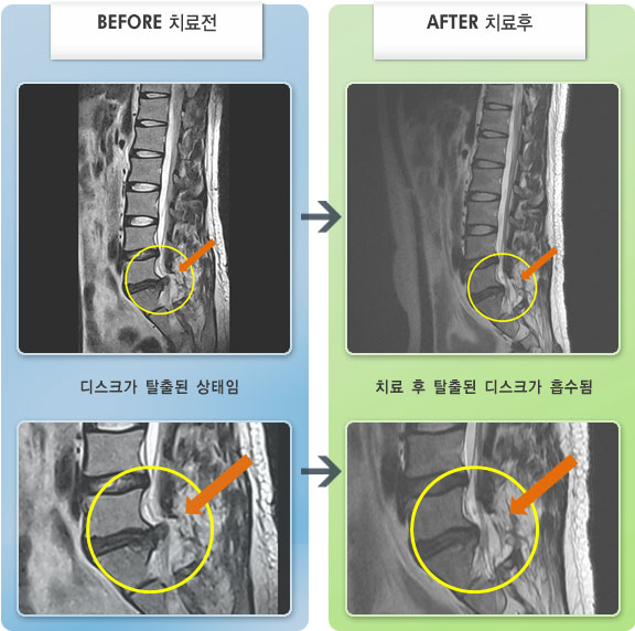 자생한방병원 치료사례 MRI로 보는 치료결과-오른쪽 허벅지 및 발목 통증 