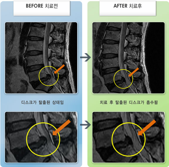 자생한방병원 치료사례 MRI로 보는 치료결과-허리 통증과 왼쪽 다리 통증