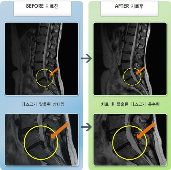 자생한방병원 치료사례 MRI로 보는 치료결과-허리 통증과 왼쪽 다리 당김 통증
