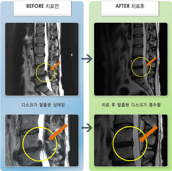 자생한방병원 치료사례 MRI로 보는 치료결과-우측 허리와 다리 통증 및 저림
