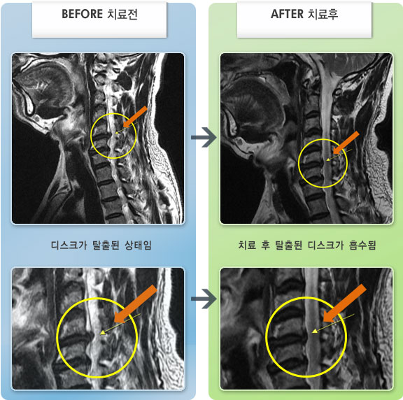 자생한방병원 치료사례 MRI로 보는 치료결과-통증과 저림이 심하여 무거운거 들면 힘이 빠지고 아림