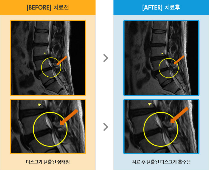 자생한방병원 치료사례 MRI로 보는 치료결과-10분정도 걸으면 양측 하지 저림과 당기는 증상