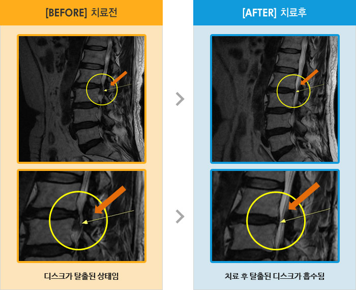 자생한방병원 치료사례 MRI로 보는 치료결과-왼쪽 허리와 다리 전체 통증