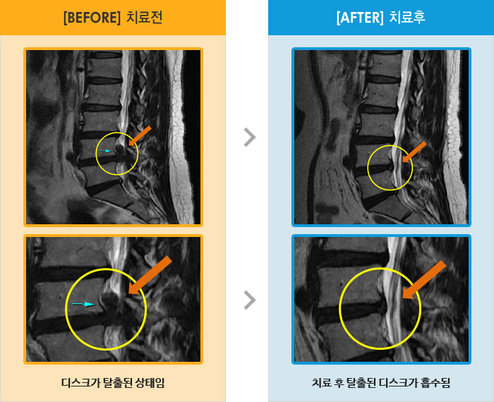 자생한방병원 치료사례 MRI로 보는 치료결과-허리 통증 및 우측 둔부 통증이 있고 우측 허벅지에서 종아리까지 통증 및 저림