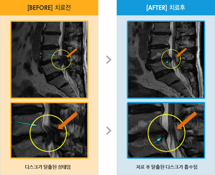 자생한방병원 치료사례 MRI로 보는 치료결과-허리 통증과 왼쪽 다리 전체 통증