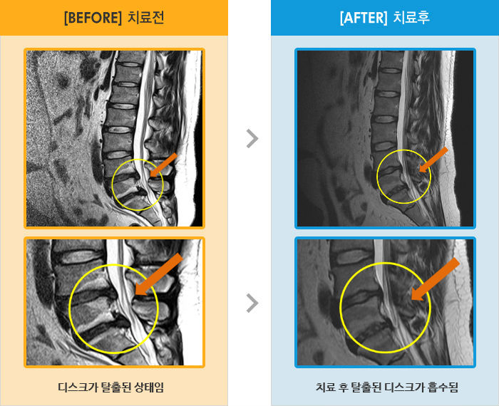 자생한방병원 치료사례 MRI로 보는 치료결과-허리 심한 통증 및 엉치 불편한 상태