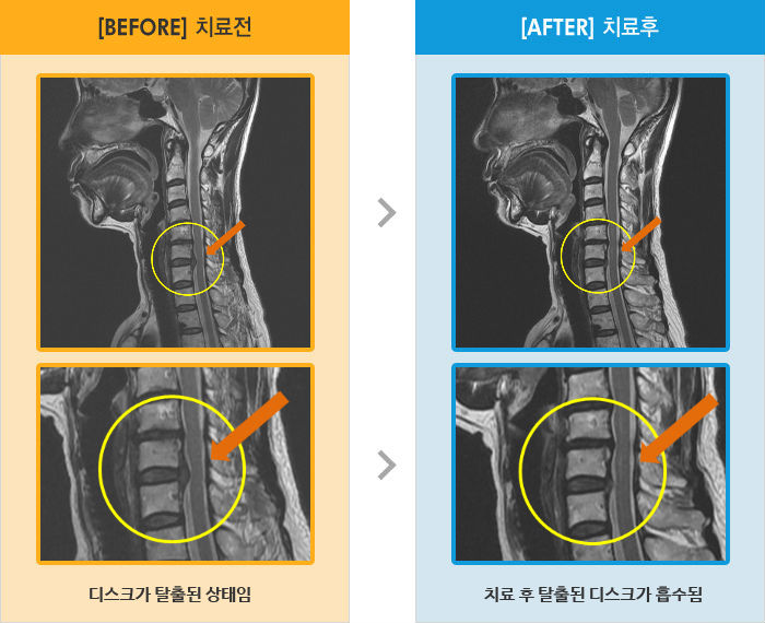 자생한방병원 치료사례 MRI로 보는 치료결과-오른쪽 목,어깨 통증 및 팔에 심한 저림과 당김