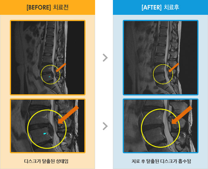 자생한방병원 치료사례 MRI로 보는 치료결과-허리 심한 통증과 좌측 다리 통증