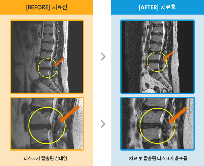 자생한방병원 치료사례 MRI로 보는 치료결과-우측 골반에서 발바닥까지 저림