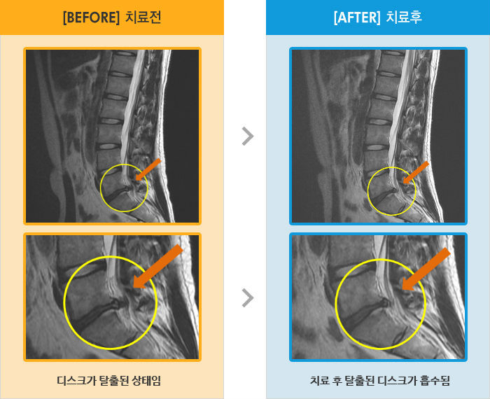 자생한방병원 치료사례 MRI로 보는 치료결과-죄측 골반에서 다리까지 당김과 저림이 있고 앉거나 기침하면 통증
