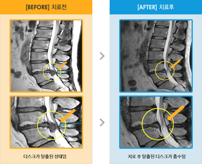 자생한방병원 치료사례 MRI로 보는 치료결과-허리와 왼쪽 다리 통증이 있고 걸으면 더욱 심해짐