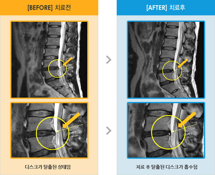 자생한방병원 치료사례 MRI로 보는 치료결과-허리 통증과 골반이 틀어진 느낌