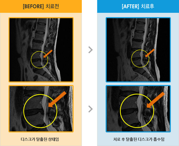 자생한방병원 치료사례 MRI로 보는 치료결과-허리와 오른쪽 다리 통증 및 저림이 있고 자세변경시, 좌위시, 보행시 통증