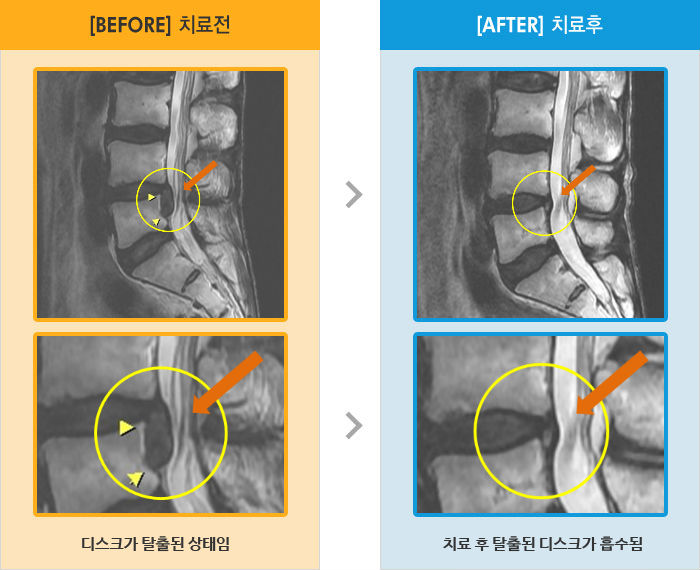 자생한방병원 치료사례 MRI로 보는 치료결과-좌측 엉치에서 종아리까지 통증