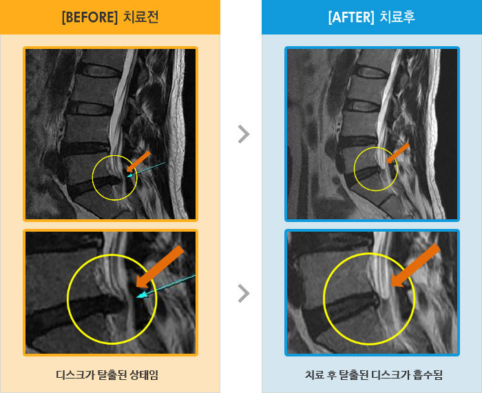 자생한방병원 치료사례 MRI로 보는 치료결과-허리와 오른쪽 다리 통증