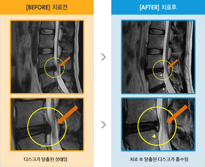 자생한방병원 치료사례 MRI로 보는 치료결과-보행시, 좌위시, 자세변경시 허리 통증이 심함