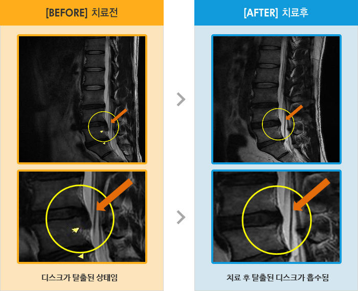 자생한방병원 치료사례 MRI로 보는 치료결과-허리 통증과 왼쪽 종아리에서 엄지발가락으로 저림과 통증