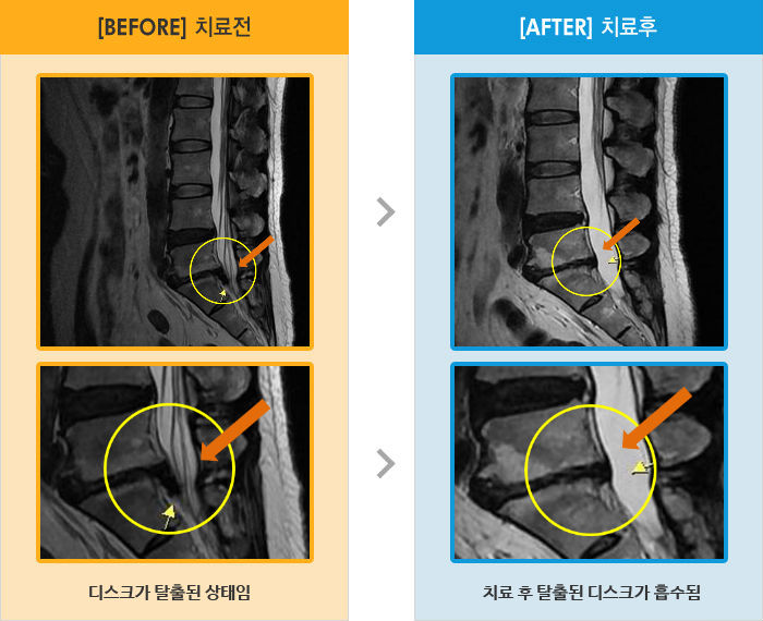 자생한방병원 치료사례 MRI로 보는 치료결과-보행시 통증은 줄었으나 좌위시 왼쪽 골반 통증